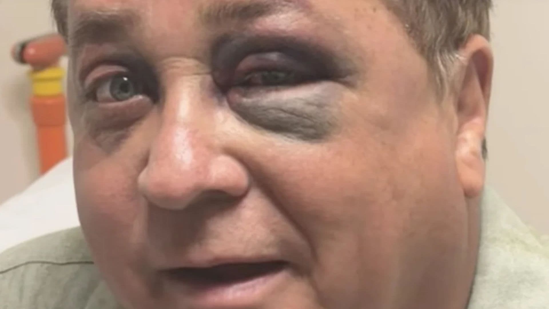 Leonardo aparece com o olho roxo no hospital e revela acidente