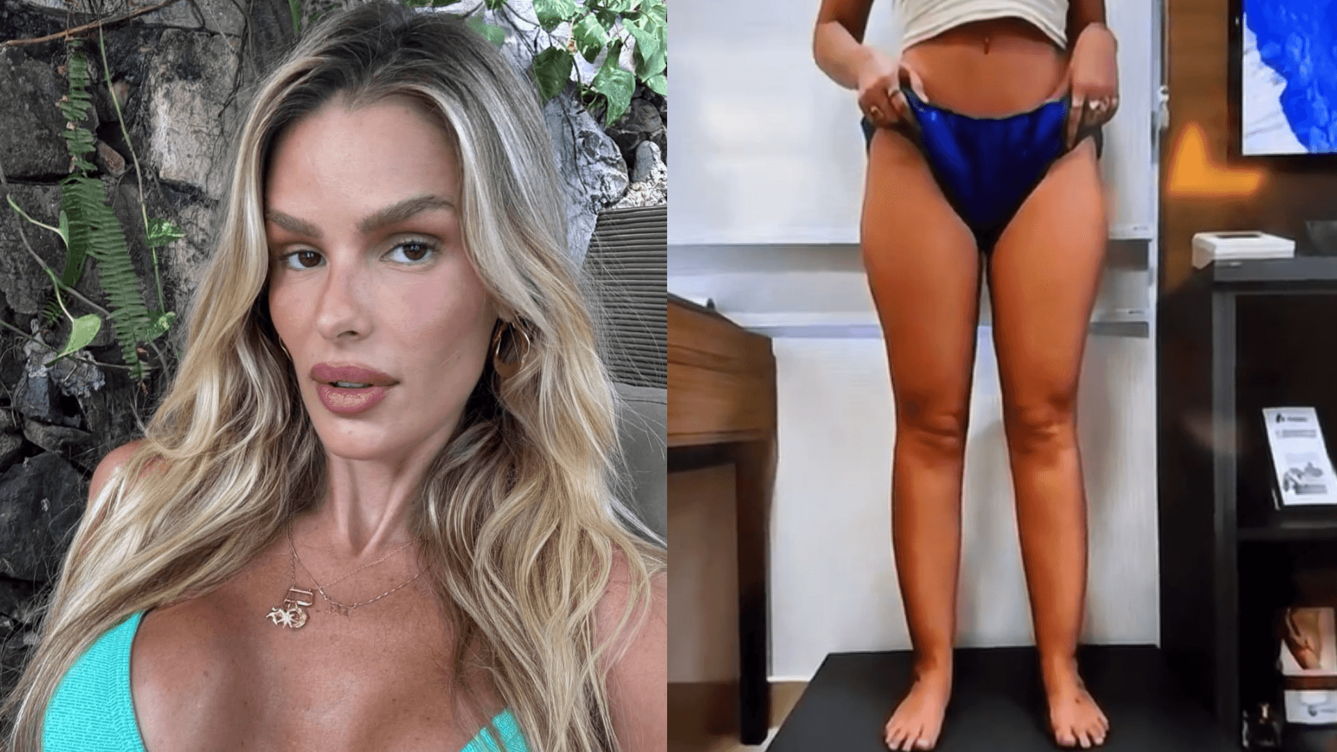Após tratamento de lipedema, Yasmin Brunet impressiona ao mostrar antes e depois da perda de 25 kg