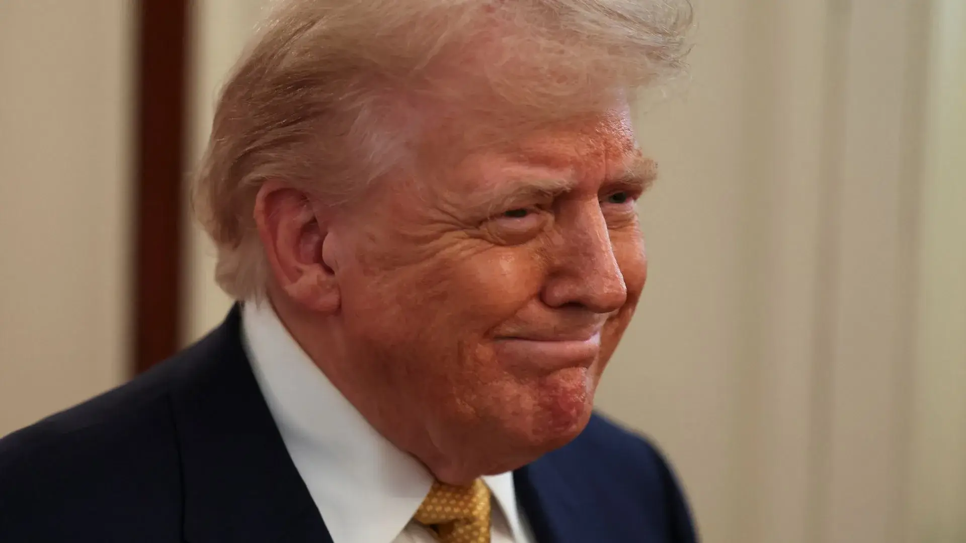 Donald Trump é diagnosticado com insuficiência venosa crônica