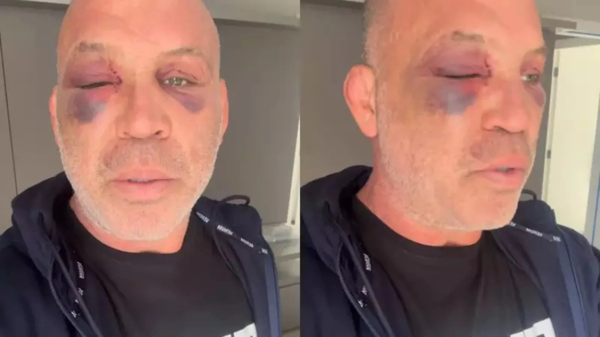 Wanderlei Silva denuncia agressão sofrida em evento de luta e expõe sequelas