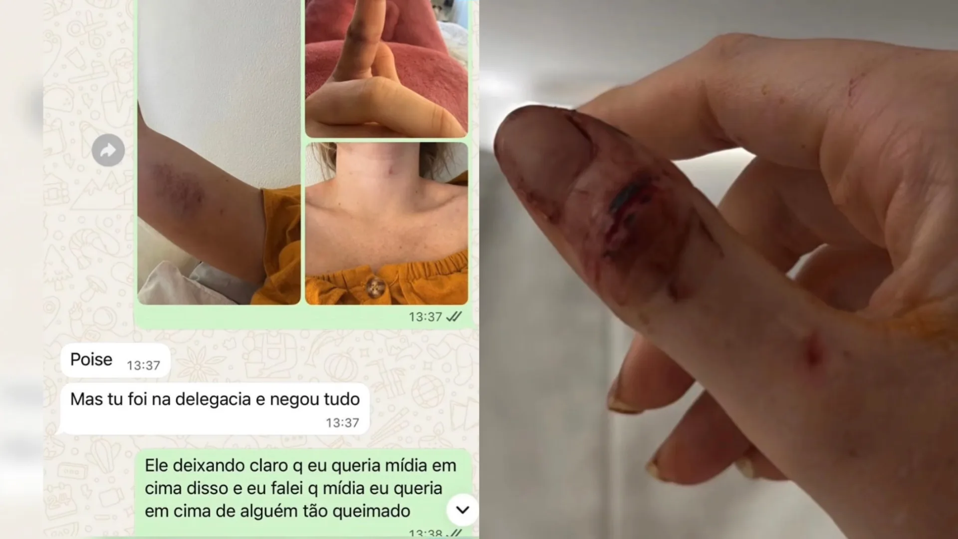 Marcela Tomaszewski publica fotos de agressões e expõe novas evidências contra Dado Dolabella
