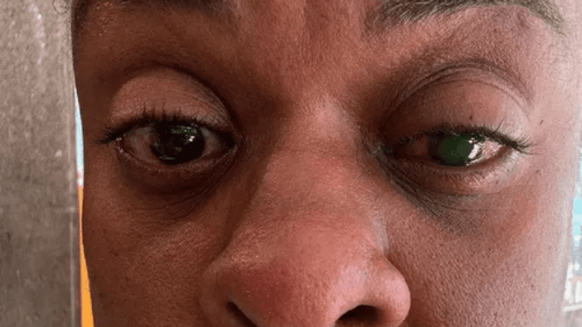 Cacau Protásio relata reação grave após uso de pomada capilar e assusta fãs