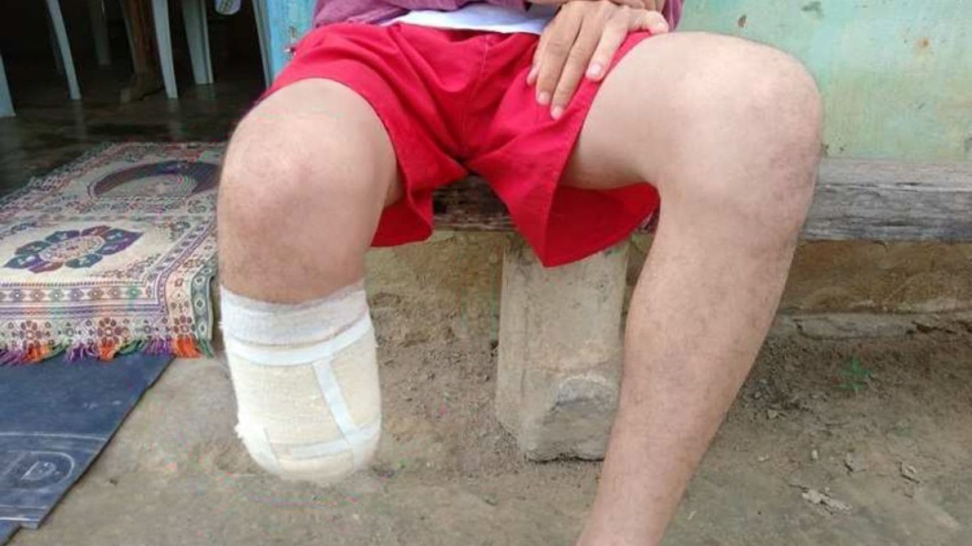 Homem amputa o próprio pé para tentar receber indenização de R$ 1,5 milhão