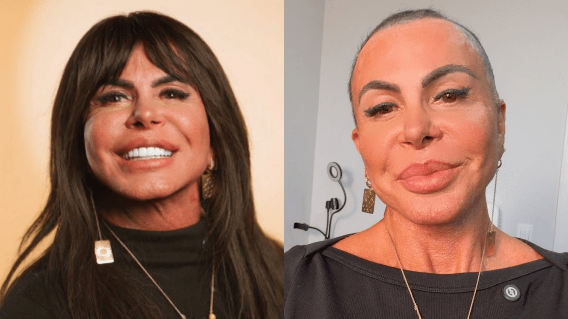 Gretchen remove lace, mostra cabelo natural e explica decisão de raspar os fios antes de transplante capilar